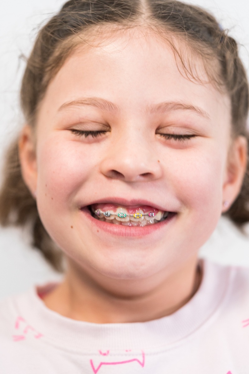 aparato dental de colores en Córdoba